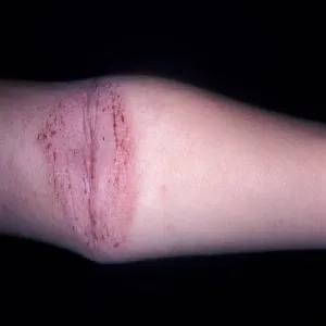 Atopowe zapalenie skóry na zgięciu ręki