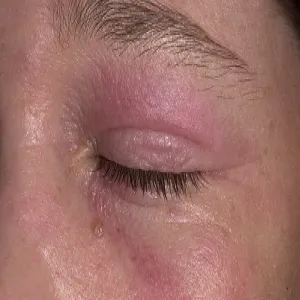 Atopowe zapalenie skóry oka