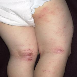 Atopowe zapalenie skóry pod kolanem