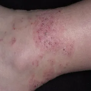 Atopowe zapalenie skóry u dorosłych