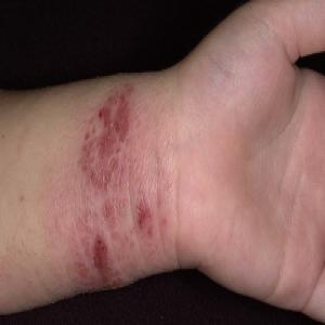 Atopowe zapalenie skóry u dzieci na rękach