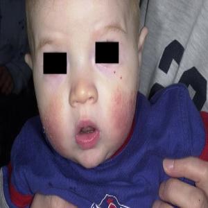 Atopowe zapalenie skóry u niemowlaka