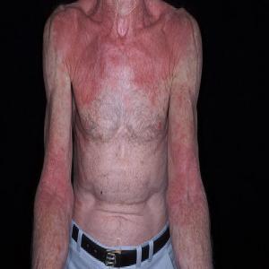 Atopowe zapalenie skóry u starszej osoby