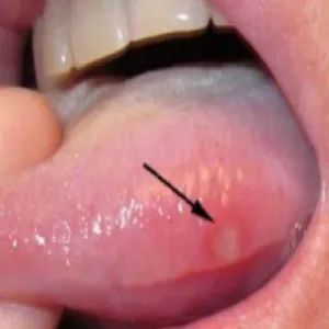 Ból języka z boku ropień języka