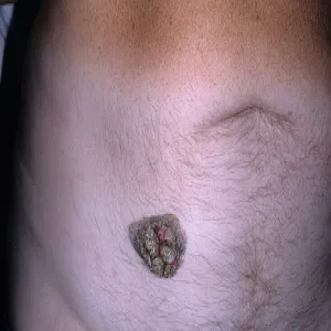 Brodawka łojotokowa na brzuchu