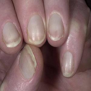 Biała płytka paznokcia choroba Terrego