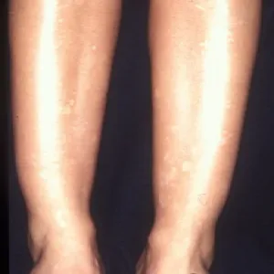 Białawe plamy na skórze - zanik plamisty skóry