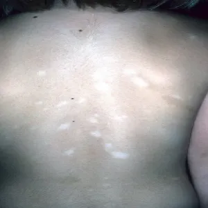 Białe plamy na plecach