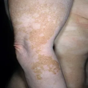 Bielactwo na skórze 