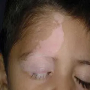 Bielactwo wrodzone u dziecka