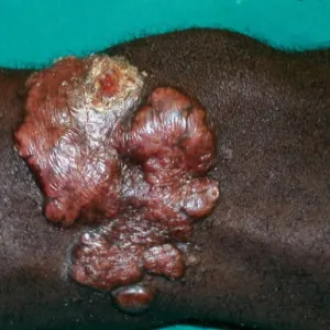 Blastomykoza drożdżyca amerykańska