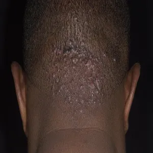 Bolące i swędzące blizny na głowie