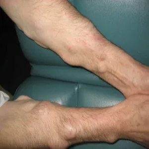 Bolesne tłuszczaki w tkance podskórnej choroba Dercuma