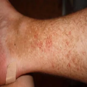 Brązowe plamy i wysypka na skórze nóg 