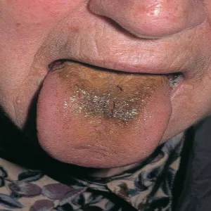 Brązowy nalot na języku