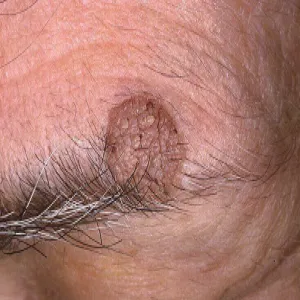 Brodawka łojotokowa na powiece