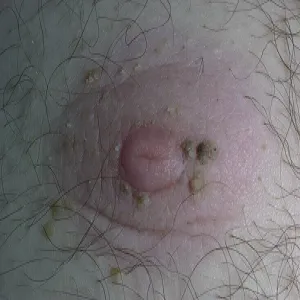 Brodawki łojotokowe na piersiach u mężczyzn