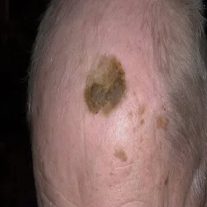 Brodawki łojotokowe na skórze głowy