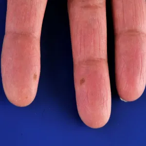 Brodawki na palcach dłoni