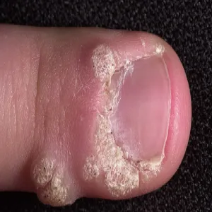 Brodawki okołopaznokciowe