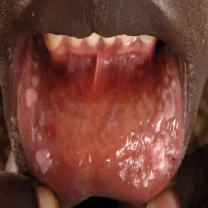 Brodawki weneryczne jamy ustnej