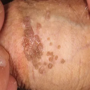 Brodawki weneryczne u mężczyzn