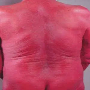 Chłoniak T-komórkowy zespół Sezary’ego 