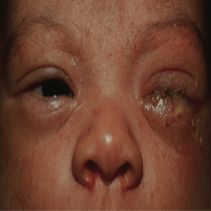 Chlamydia oka u noworodka