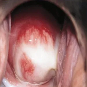 Chlamydia wydzieliny ropne z pochwy