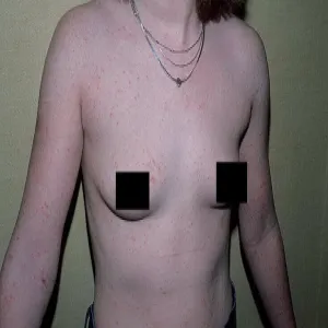 Choroba świerzb u nastolatki