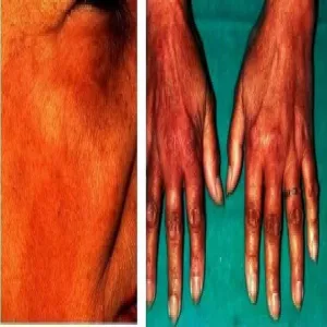 Choroba Addisona objawy skórne