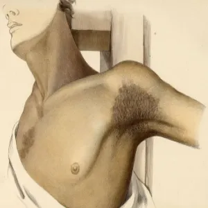 Choroba Addisona zmiany pigmentacji skóry