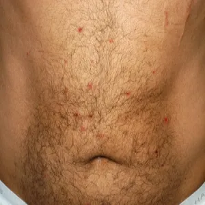 Choroba Behçeta objawy skórne