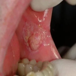 Choroba Bowena jama ustna