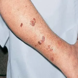 Choroba Bowena na nodze