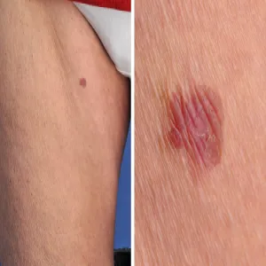 Choroba Bowena na udzie