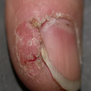 Choroba Bowena palca