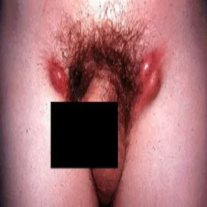 Choroba Duranda-Nicolasa-Favre'a