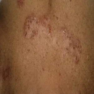 Choroba Haileya-Haileya na skórze