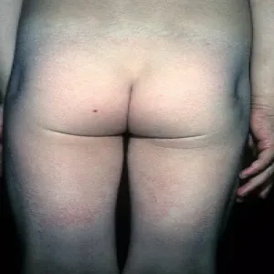 Choroba Kawasaki u dorosłych