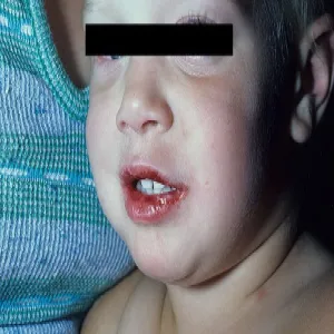 Choroba Kawasaki u dzieci