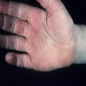 Choroba Kawasakiego u dorosłych 