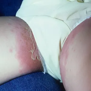 Choroba Kawasakiego u dzieci