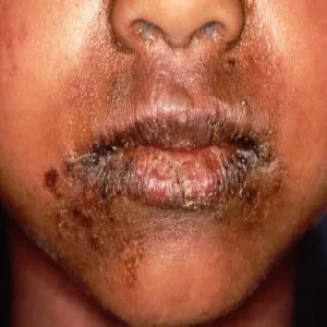 Choroba Rittera u dzieci