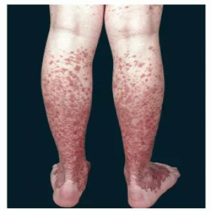 Choroba Schamberga na nogach