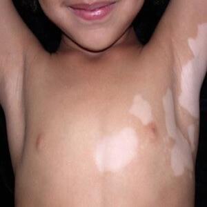 Choroba bielactwo u dzieci