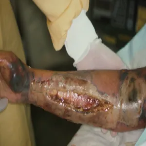 Choroba gangrena zgorzel właściwa 