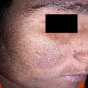 Choroba genetyczna u człowieka skóra pergaminowata-barwnikowa