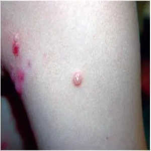 Choroba mięczak zakaźny 