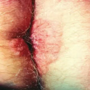 Choroba nowotworowa odbytu pozasutkowa choroba Pageta 